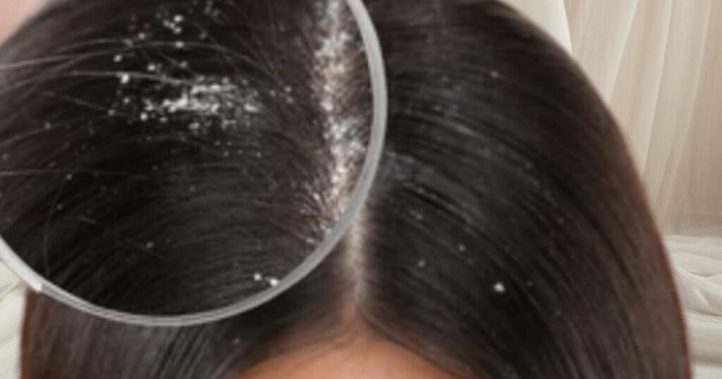 How to Get Rid of Dandruff Fast: Home Remedies That Actually Work
