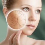 Get Rid of Dry Skin on Face Naturally