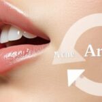 How to Choose the Right Toner for Acne: Dermatologist-Approved Tips