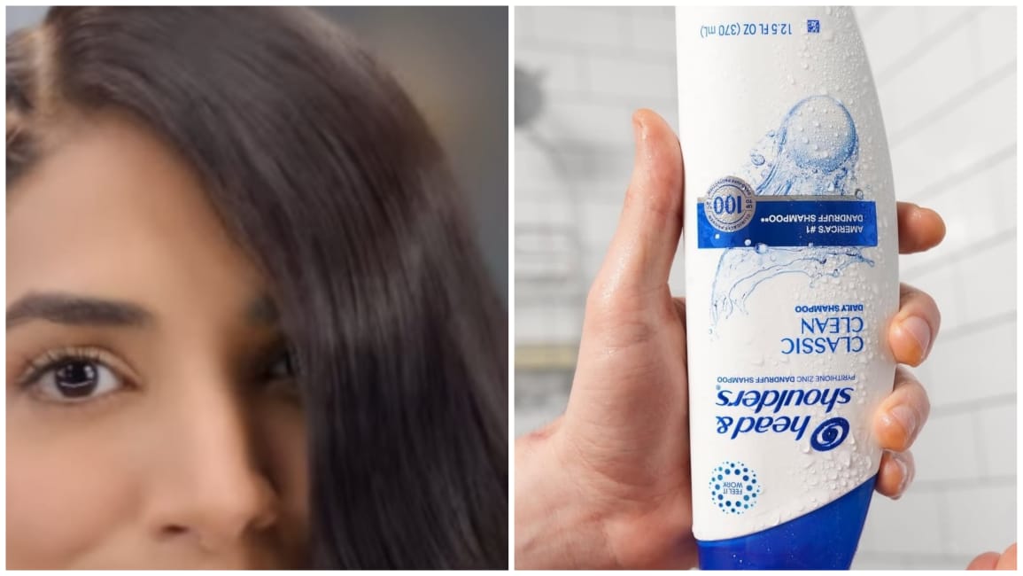 Does Head and Shoulders Cause Hair Loss